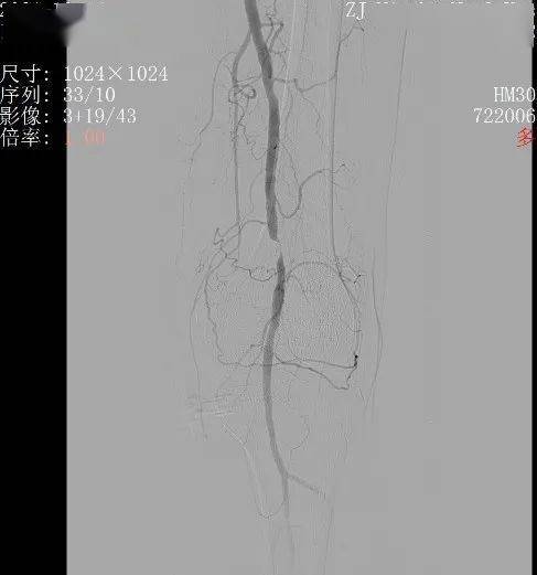 (治疗前造影见腘动脉p1段明显闭塞)(导丝通过后予以2.