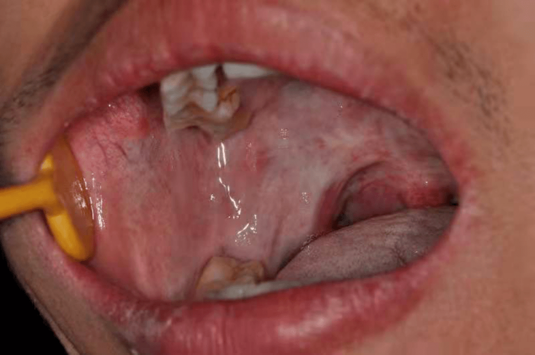 随着咀嚼槟榔的时间和数量的增加,口腔黏膜下纤维化最终恶变为口腔癌