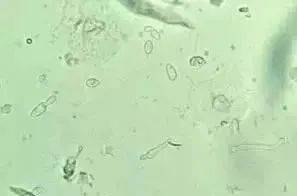 阴道分泌物白带常规检查及镜检图片
