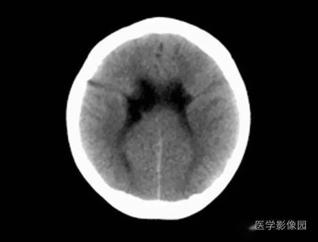 颅脑先天畸形ct诊断必须知道这8种