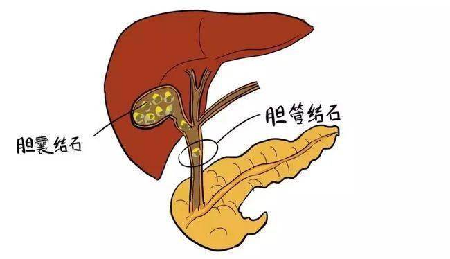 化脓性胆管炎疼得面无血色,医生ercp了一下,竟治愈了!