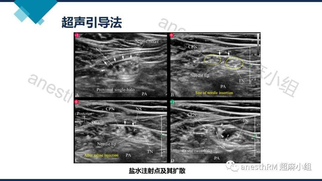 超声引导下腘窝坐骨神经阻滞