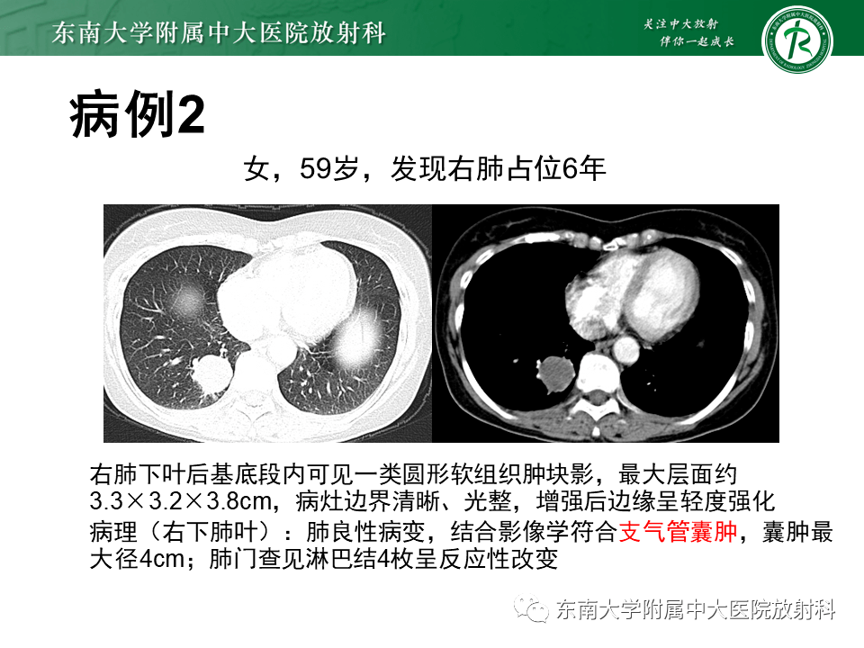 肺内支气管囊肿_影像_常读_微信