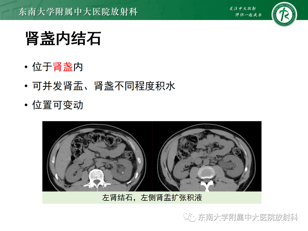 髓质海绵肾影像表现