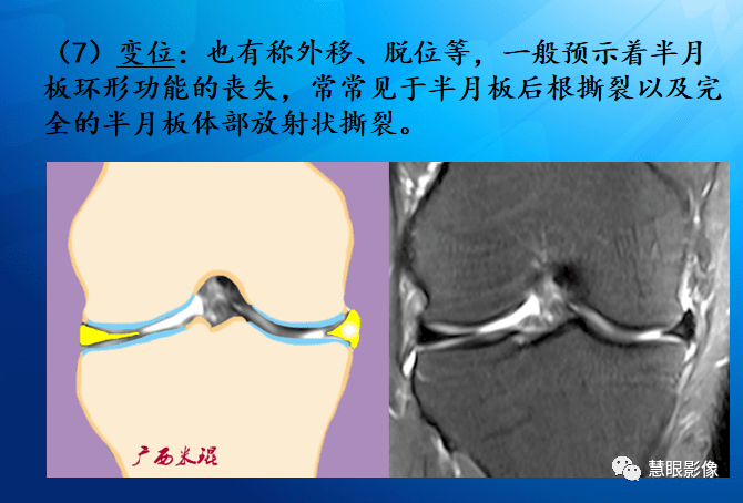 mri半月板损伤基础