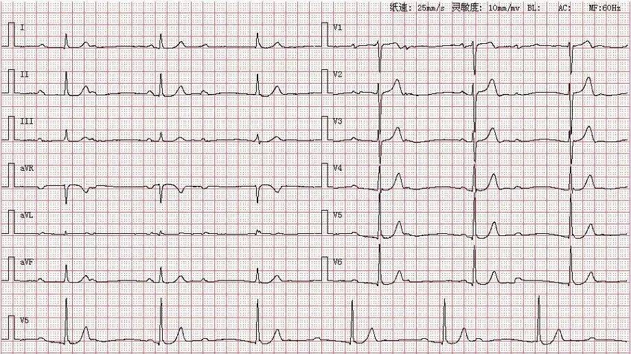 心电图库丨三度房室传导阻滞系列