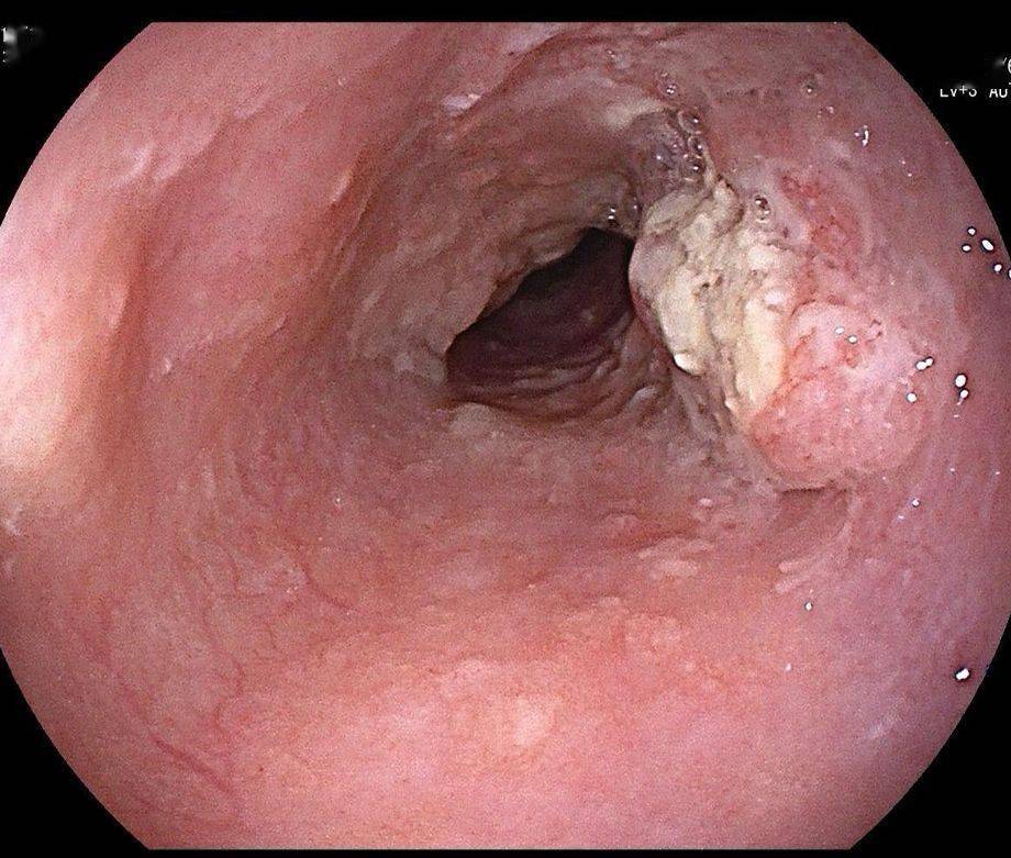 先来接受一段惊吓 这是正常的食管  (正常食管黏膜,光滑柔软) 左右