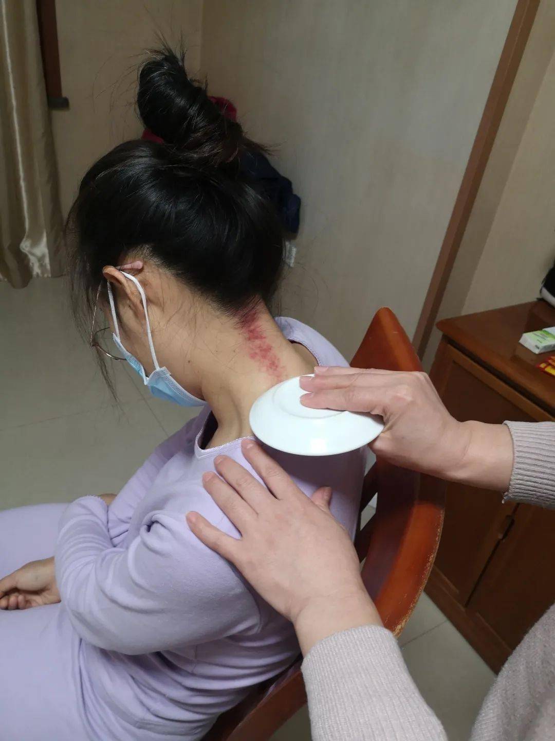 护士王艳因为工作量过大出现颈椎病复发后,她又当起了队医,为王艳刮痧