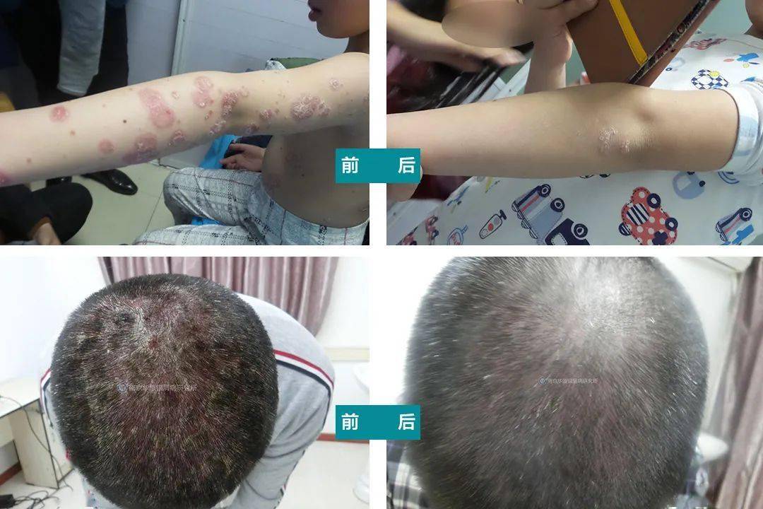 张学军教授指出:银屑病遵循早发现,早诊断,早治疗的原则,早期的银屑