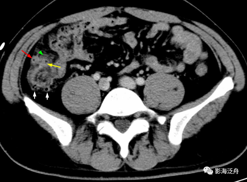 小心误诊,这可不是急性阑尾炎!_盲肠_病例_诊断