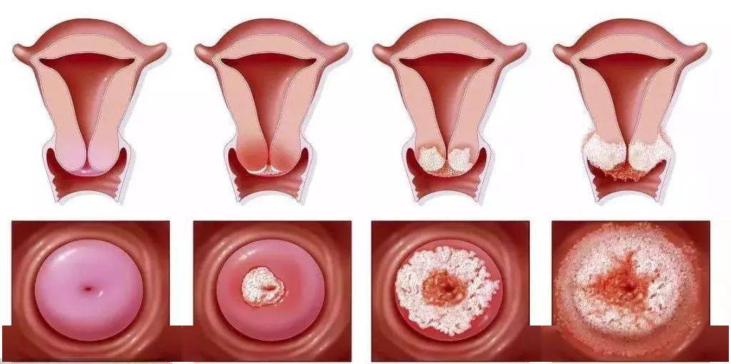 从阴道炎到宫颈癌这五大子宫垃圾才是罪魁祸首
