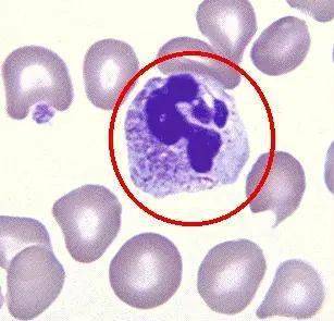 含中毒颗粒的中性粒细胞应与嗜碱粒细胞区别,其要点:嗜碱粒细胞核较少
