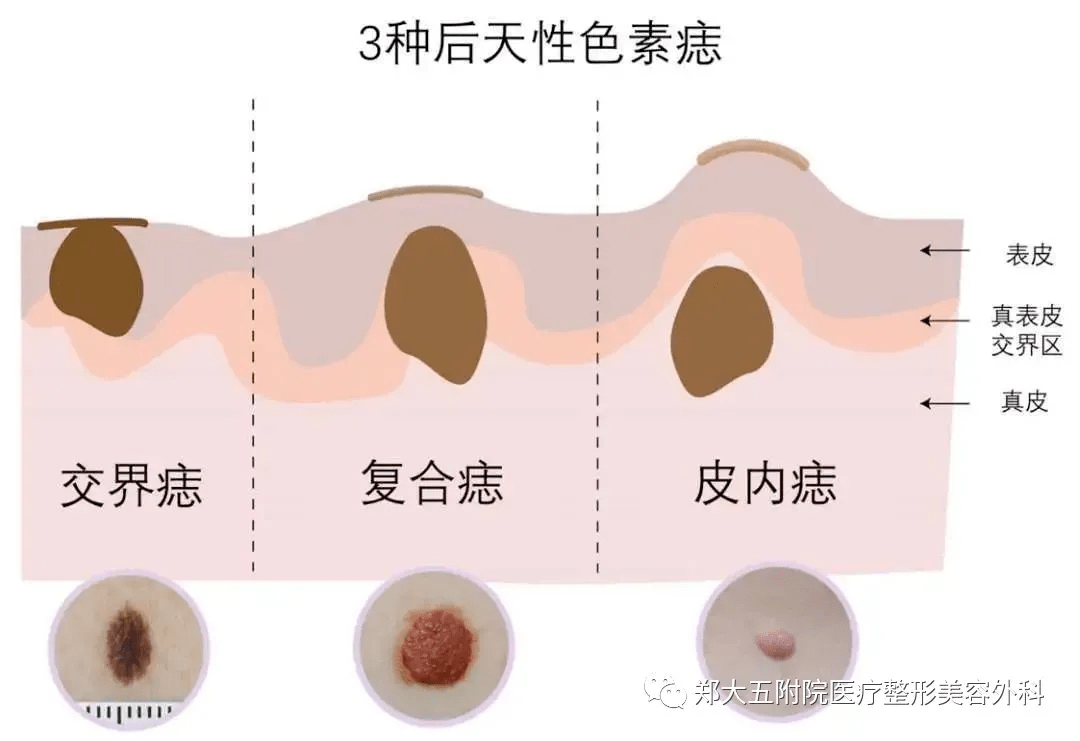 复合痣:略微突起,表面一般比较光滑,棕黄色或浅棕色.