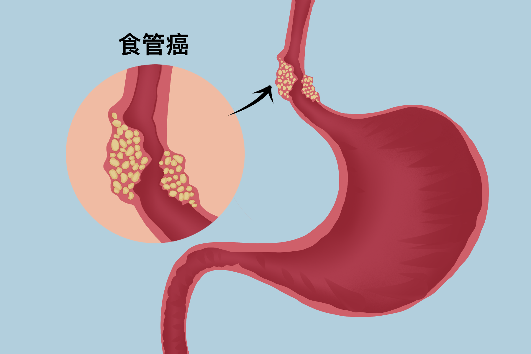 关于食管癌,你了解多少?_发病_症状_患者