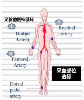 股动脉采血致大面积皮下血肿!采血后按压止血究竟要几分钟?