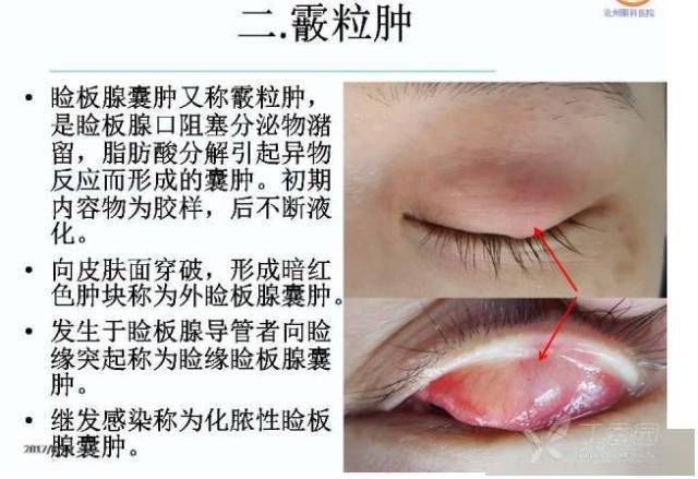 麦粒肿和霰粒肿的个体化分期治疗