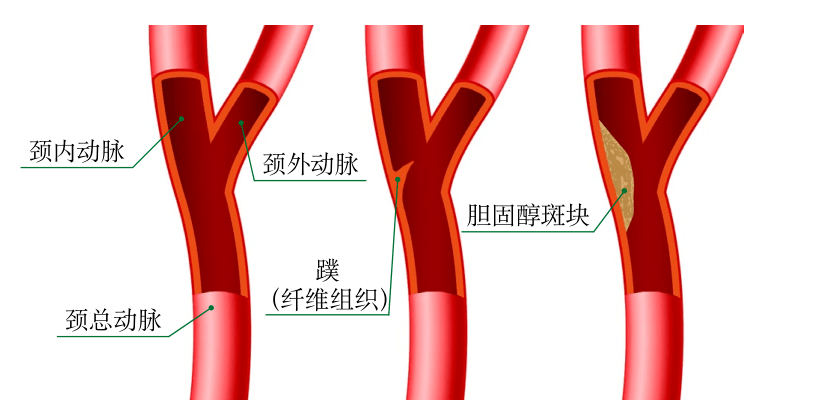 国际罕见病日好发于女性兰人医心内科确诊兰溪首例颈动脉蹼罕见病