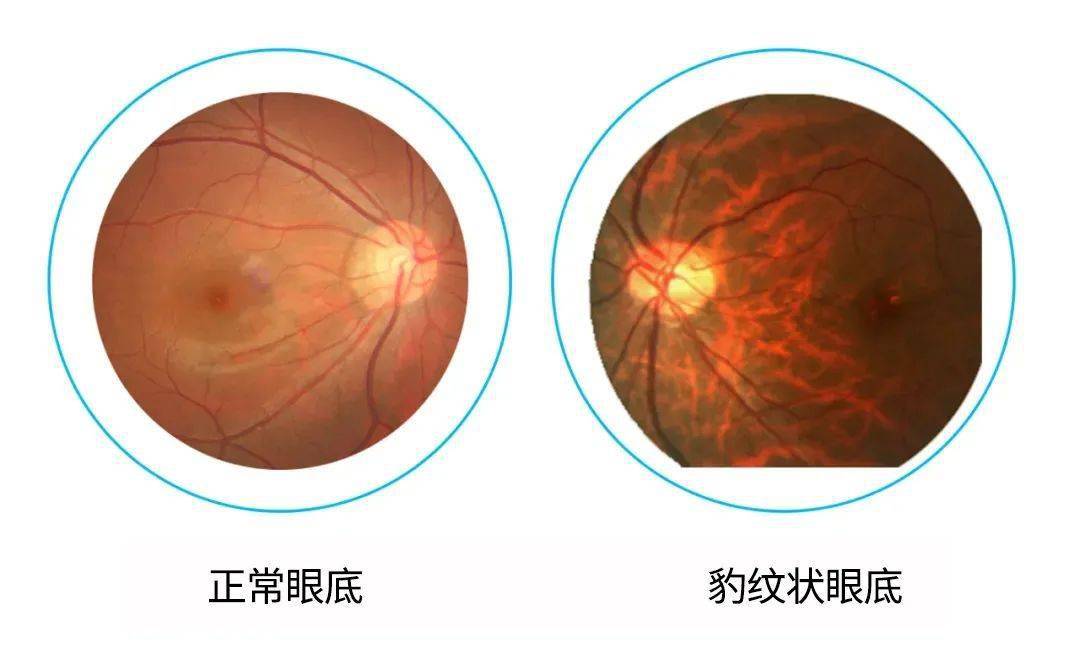 看起来就像"豹纹"一般,因此高度近视人群还会伴随有"豹纹状眼底"