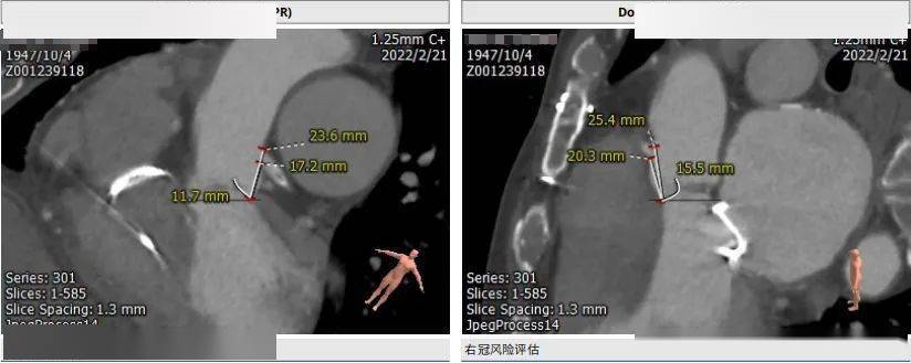 7 mm主动脉窦直径:左冠窦 31.5 mm,右冠窦31.1 mm,无冠窦36.
