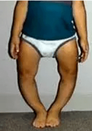 雨季高发儿童佝偻病,决非危言耸听!_维生素_缺乏性_婴幼儿