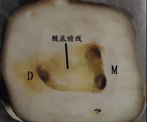根管口定位法则和探查遗漏根管的一些数据_远中_下颌_临床