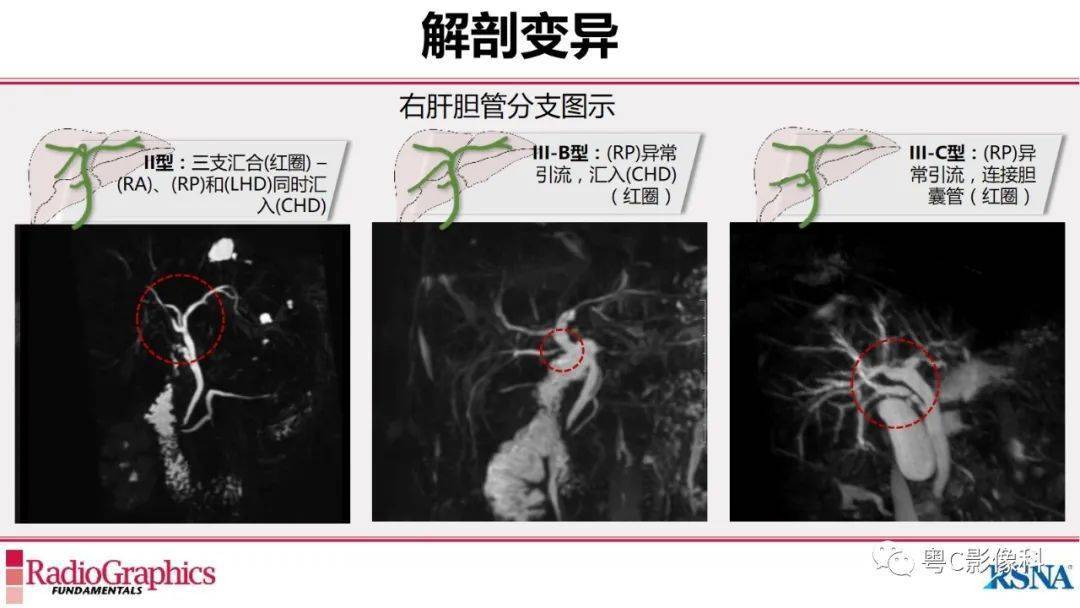 磁共振胰胆管成像mrcp放射科医生必须知道的专业知识