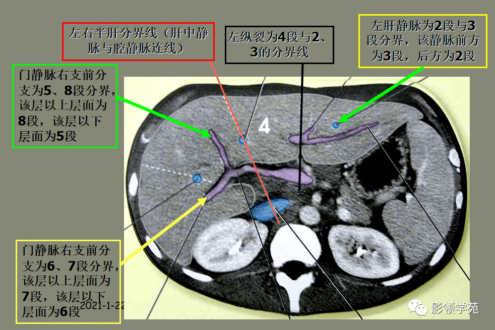 肝脏的表面解剖及分叶分段_门静脉_系统_韧带