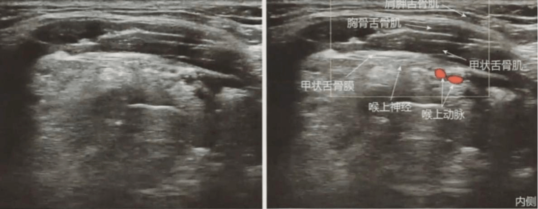 3.超声定位甲状舌骨膜(pmid:26297210)