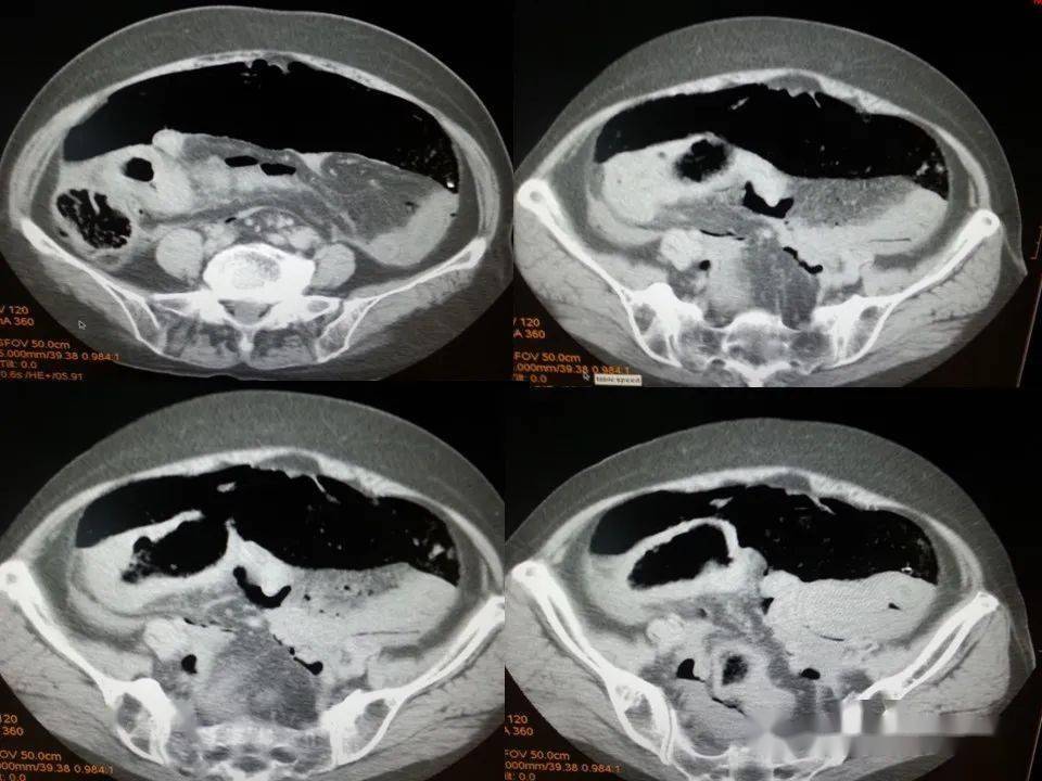 消化道穿孔ct影像大汇总看完印象深刻