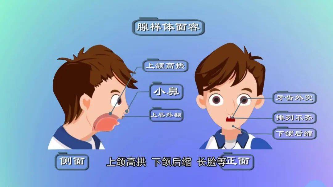 纠正误区:平时说的扁桃体也叫腭扁桃体,位于口咽两侧舌弓与腭咽弓围成