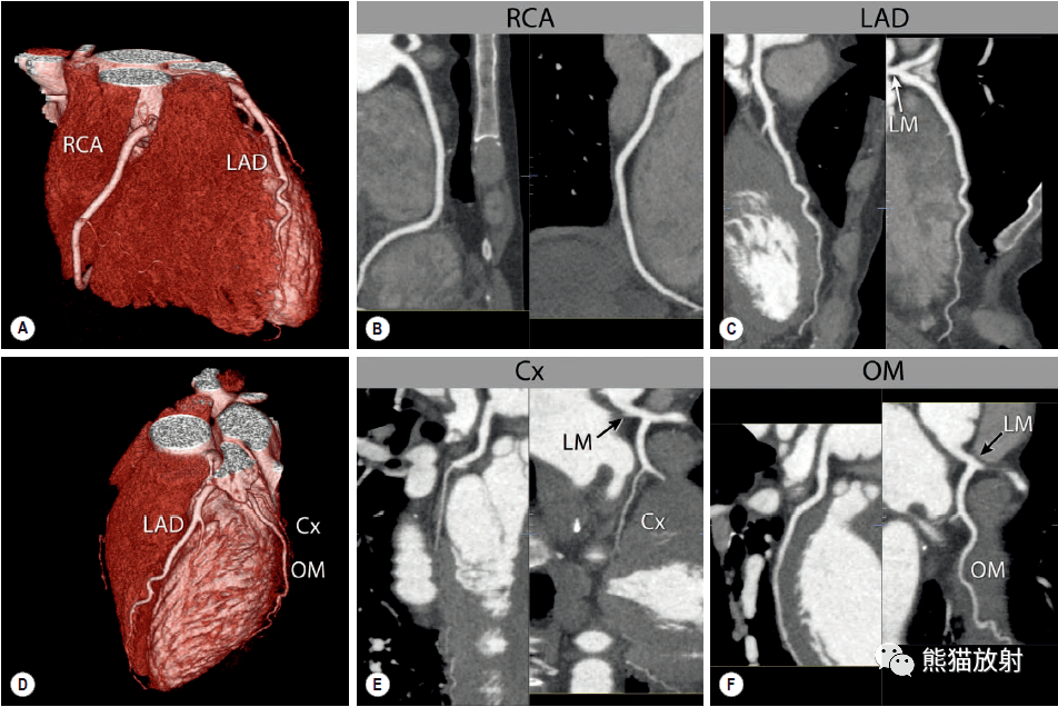 冠状动脉ct:相关概念,解剖_回旋_显示_分支