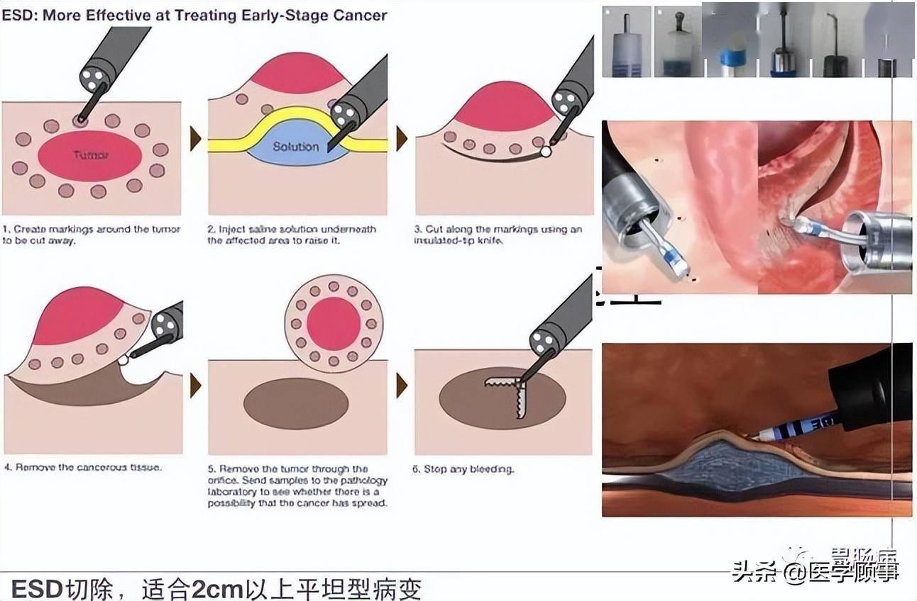 67详解内镜黏膜下剥离术esd