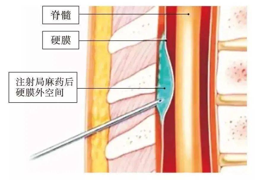 仁济科普半身麻醉后头痛怎么办
