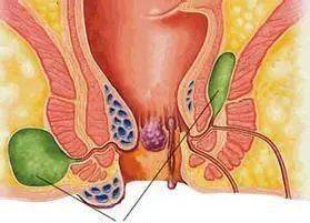 肛周起了"小肉球,乱用痔疮膏可能小命不保_肛门_症状_患者