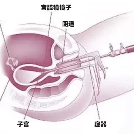 、费用低，可作为初筛手段分段诊刮：怀疑内膜癌/内膜增生的患者，最常用宫腔镜检查：可直视观察、取得病理