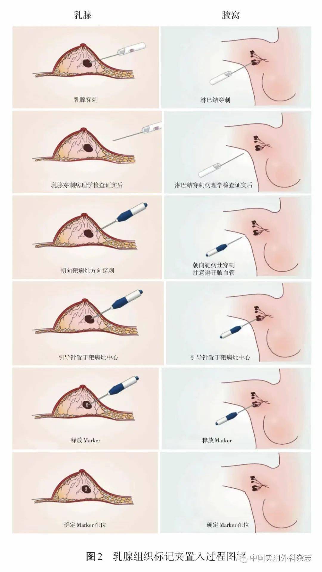 指南与共识|中国可视化经皮穿刺乳腺组织定位导丝与定位标记夹临床