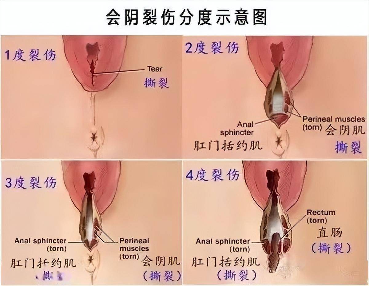 时大便不受控制。发病原因主要是自然分娩时会阴裂伤、侧切缝合不当等。