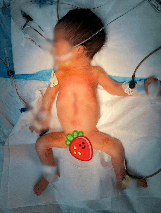 全球罕见！深圳一男婴出生时4手4脚！医生：系寄生胎！