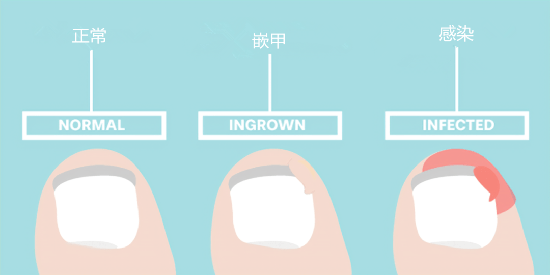 有一种痛,叫指(趾)甲长到肉里