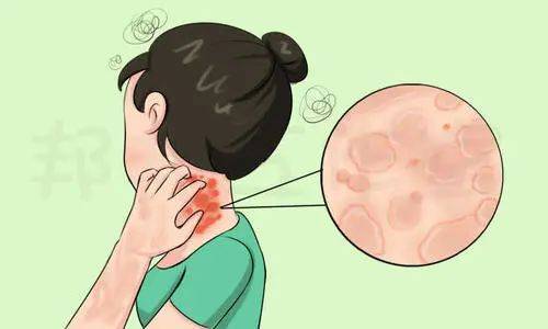 秋季皮肤总是痒痒痒，怎么办？