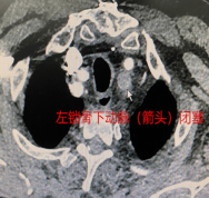 46岁男子患高血压多年,反复头晕1年,济南市中心医院