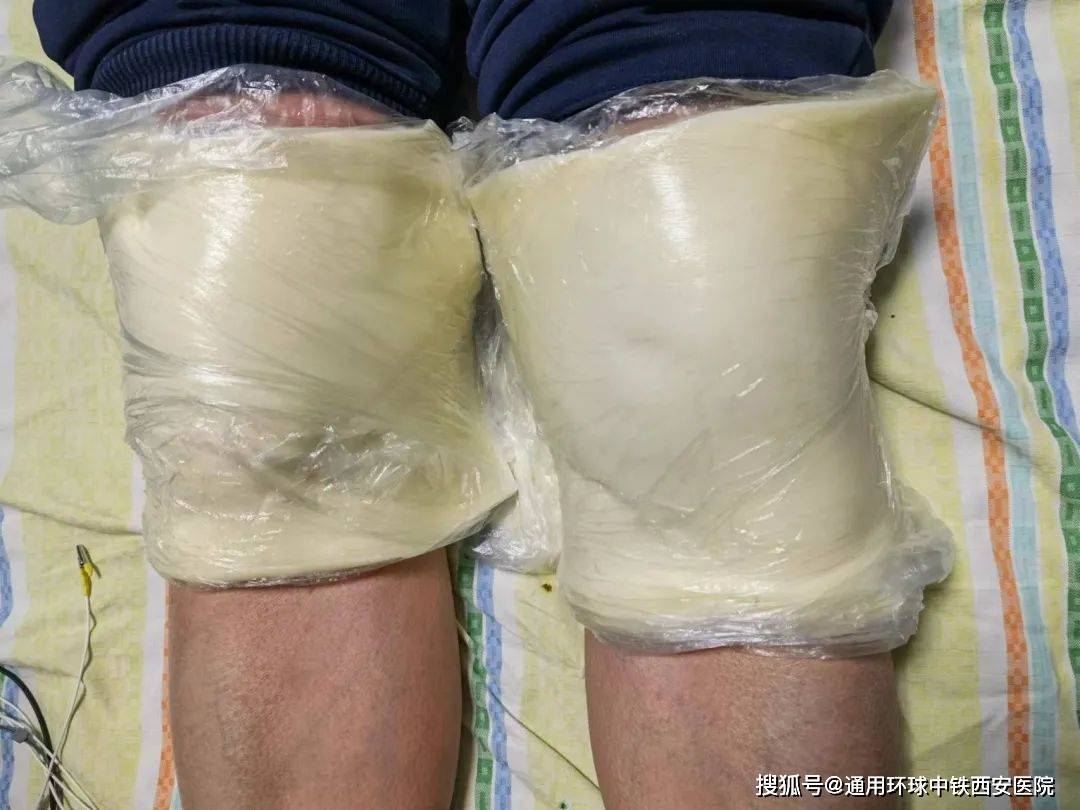 寒、疏经通络、体外松解受损的软组织，解放受卡压的皮神经，改善疼痛。治疗3天后，刘阿姨自称肿胀疼痛已缓