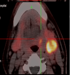 fapi-pet/ct检查显示左侧腭扁桃体见结节状fapi摄取增高病灶,左颈部