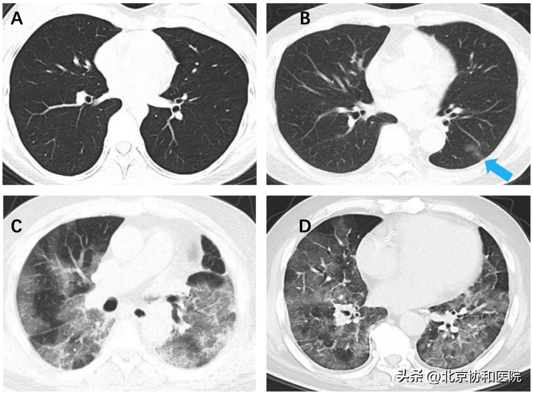协和医生说｜新冠病毒性肺炎容易发展为“白肺”吗？