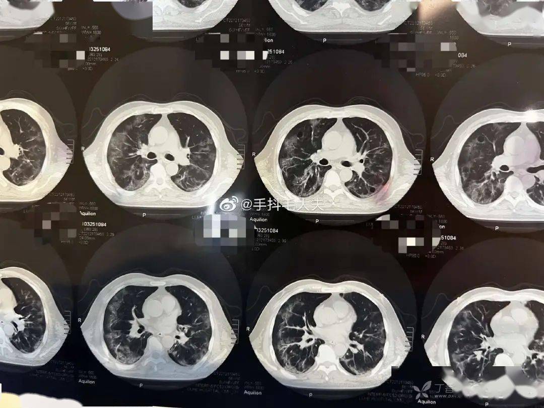 阳性 10 天无发热，肺 CT 却已千疮百孔