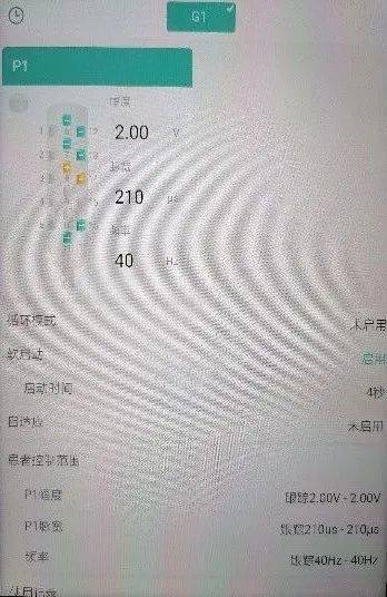 品驰特约｜重庆首例运动皮层刺激疗法治疗丘脑卒中后痛苦悲伤案例