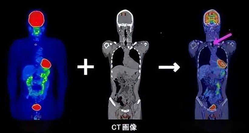 读：pet ct片和普通ct片有什么不一样？患者如何轻松看懂自己的pet ct报告？