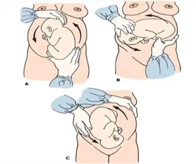 外倒转术可分前滚翻、后滚翻。 臀位或横位分娩的胎儿早产、胎膜早破及脐带脱垂的发生率高，易致窒息和产伤