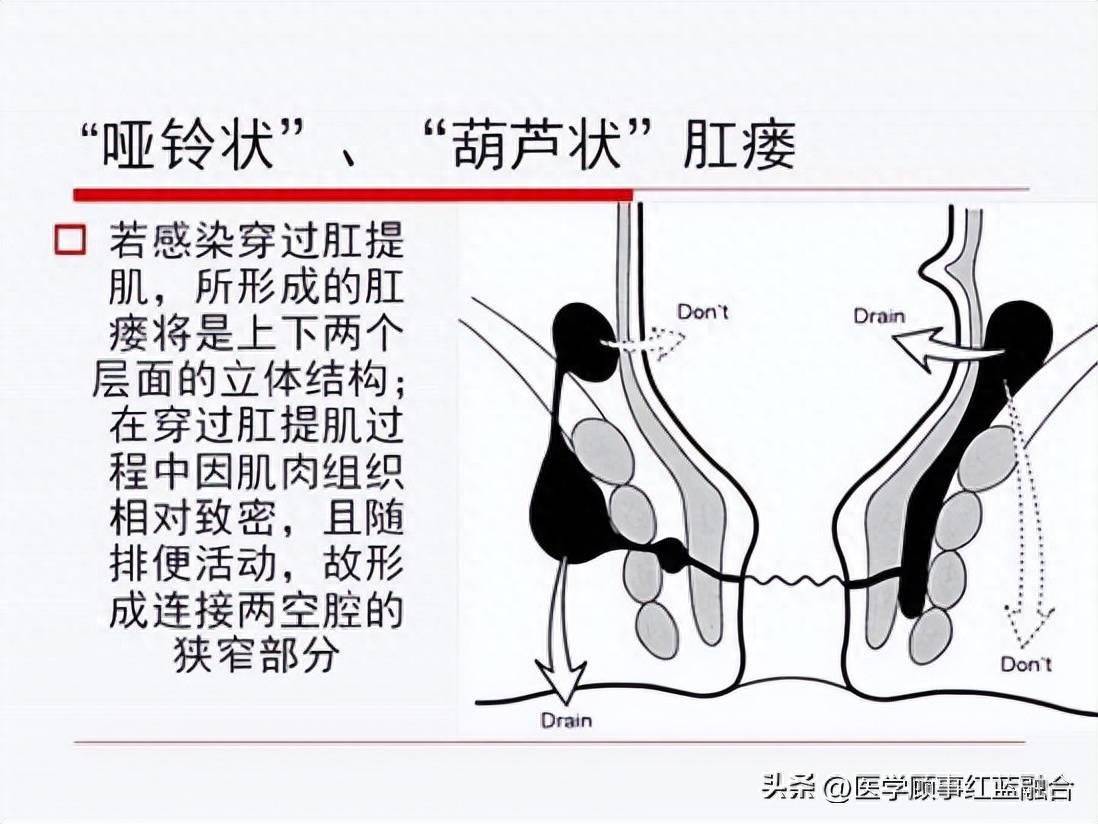 得了肛瘘如何诊治？