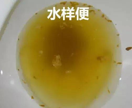；拉出来的是水样便或蛋花汤样便，疾病初期还可能有不消化的食物残渣。
